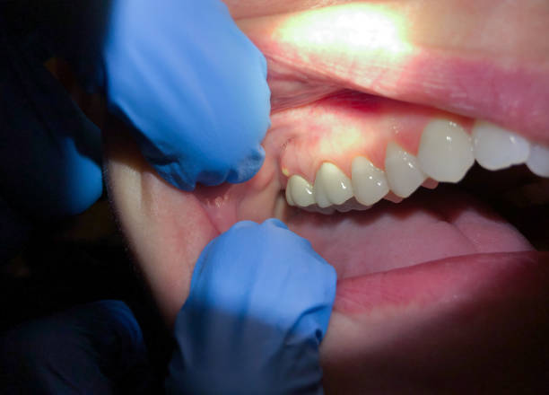 Best Knocked-Out Tooth (Avulsed Tooth) Treatment in Shepherd, MI